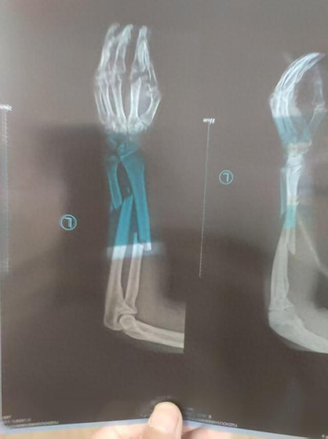 大风追踪 | “男子被钻机拧断胳膊，难获37万工伤补助金”：法院查封的800吨煤，拍卖前被矿方私售