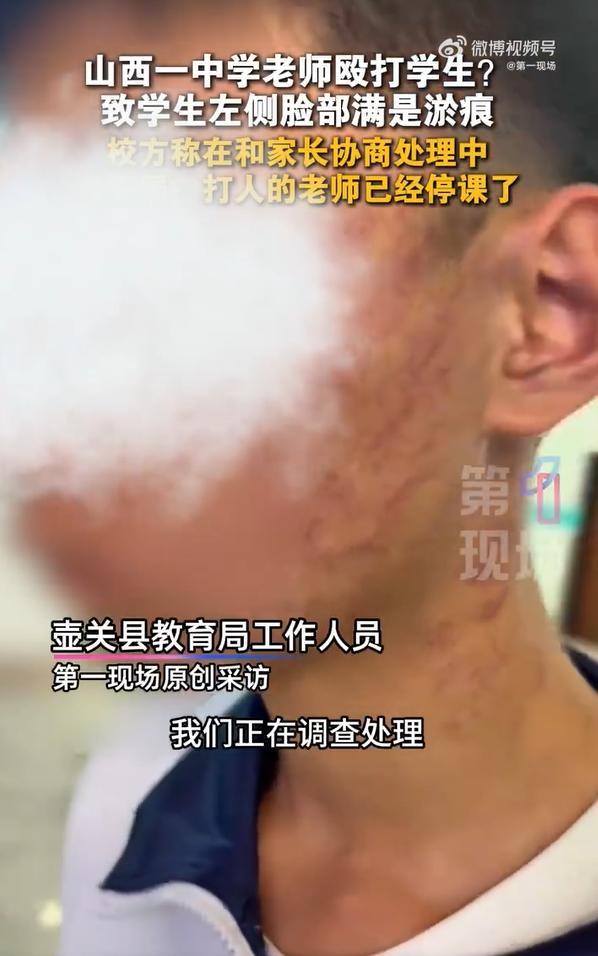 老师打学生致多处淤痕，教育惩戒不能演变成“故意伤害”